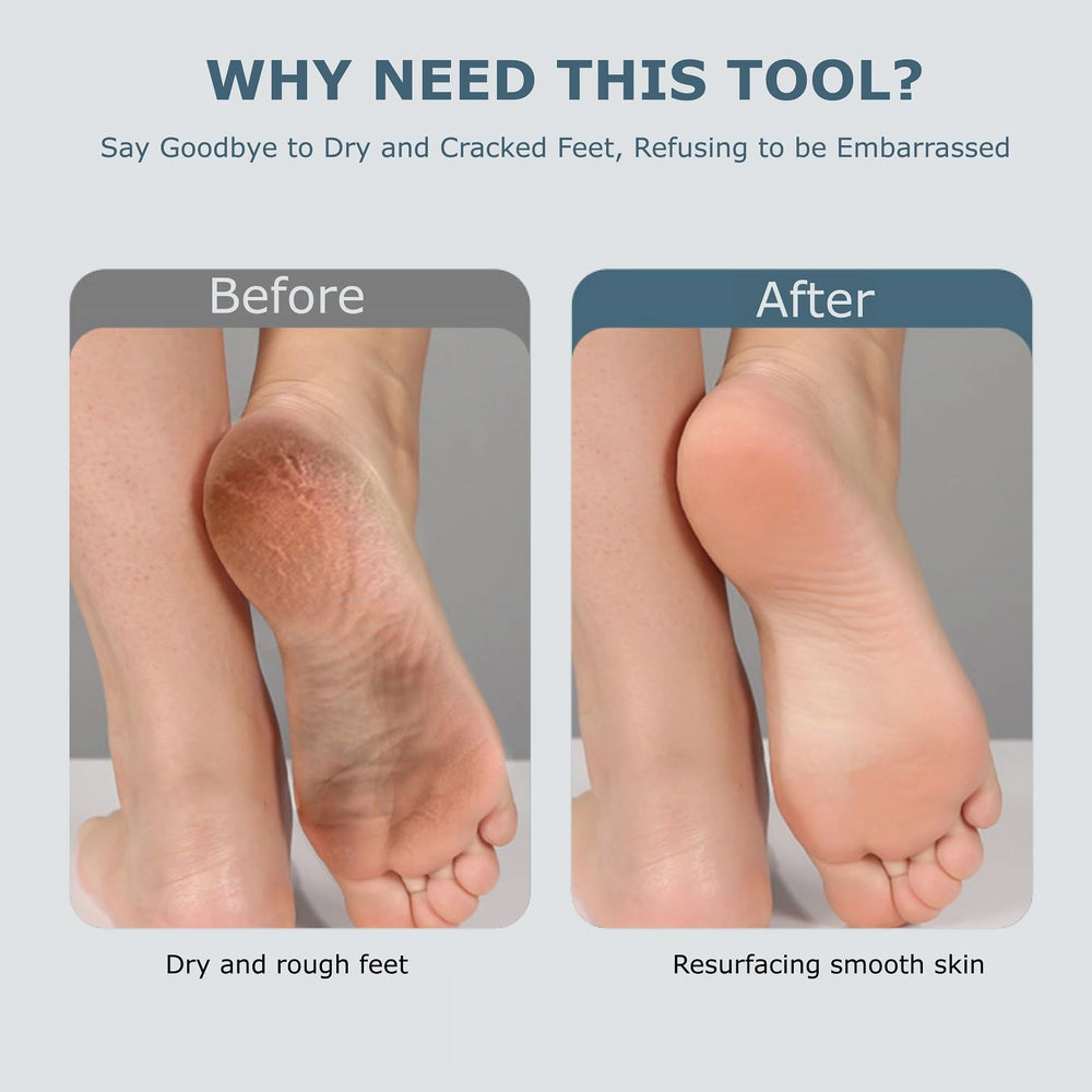 Fooseey foot care use-case showing cracked heels before and after treatment.