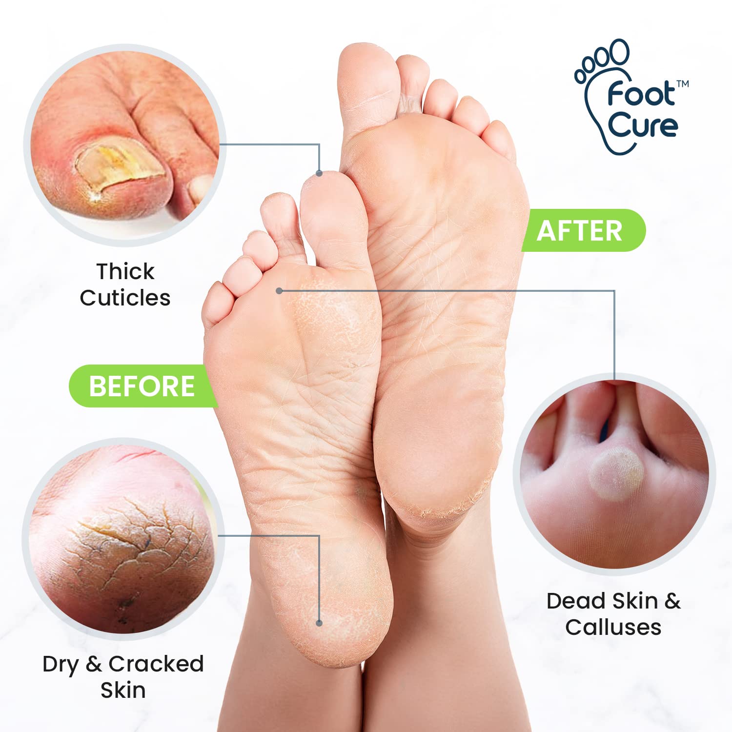 Foot Cure Callus Remover Gel tube ready for targeted callus softening.