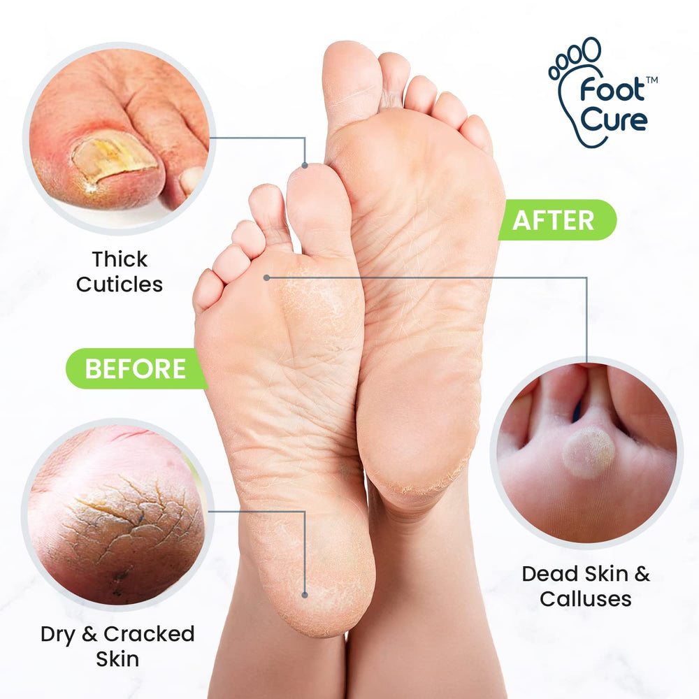 Foot Cure Callus Remover Gel tube ready for targeted callus softening.