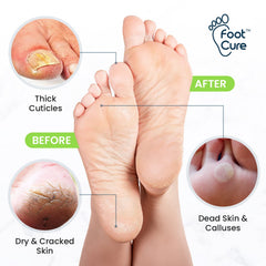 Foot Cure Callus Remover Gel tube ready for targeted callus softening.