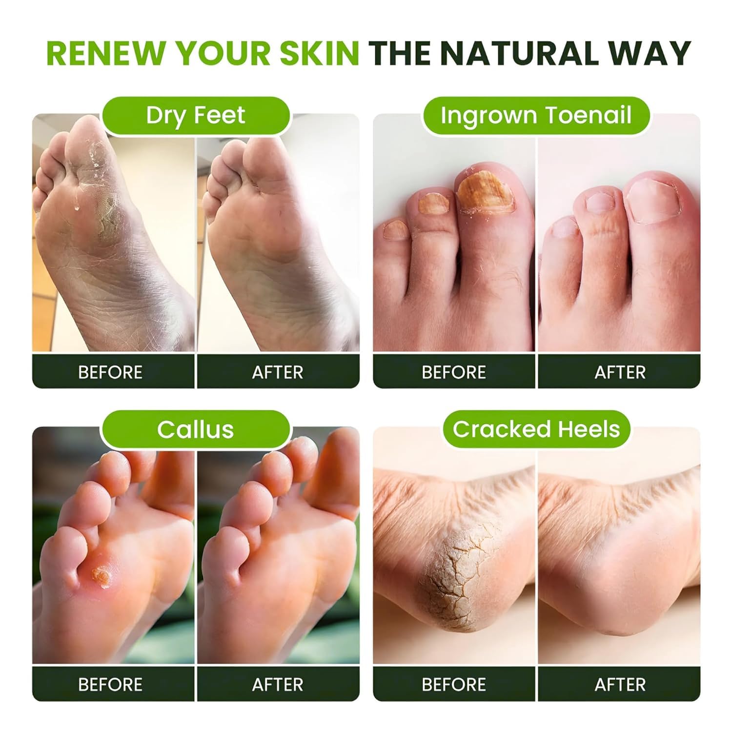 FOOT CURE packaging of 4-pack tea tree foot soak for ongoing care