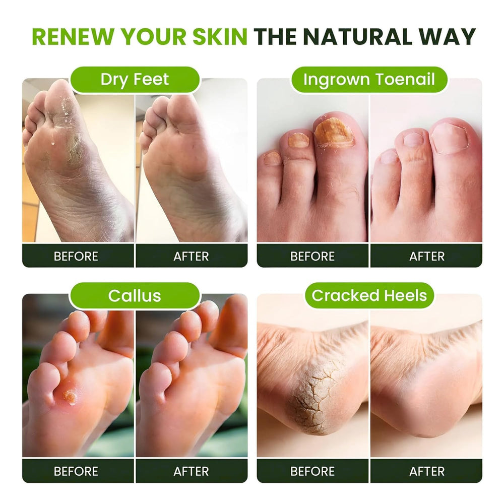 FOOT CURE packaging of 4-pack tea tree foot soak for ongoing care