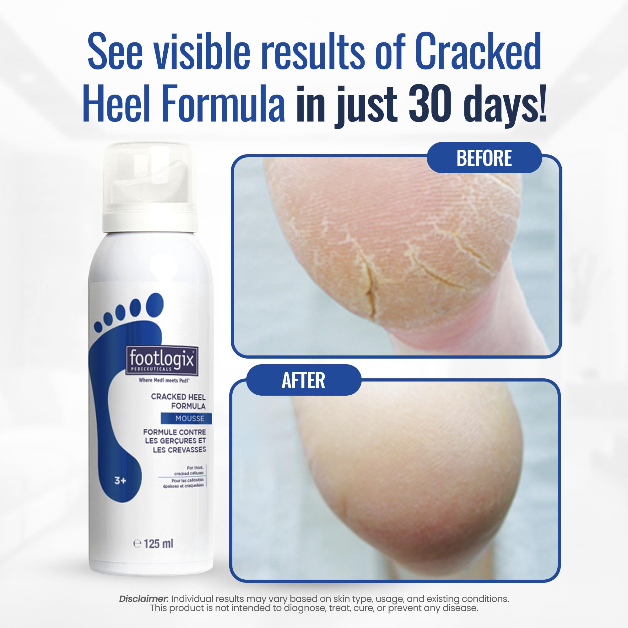 Footlogix Cracked Heel Formula label highlights Dermal Infusion Technology benefits