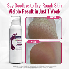 Footlogix Rough Skin Formula heel skin close-up showing dryness relief