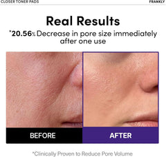 FRANKLY Pore Closer Toner Pad peptide blend tightens pores.
