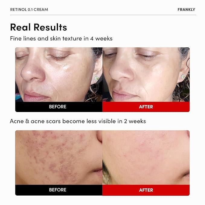 FRANKLY retinol application on skin demonstrates beginner-friendly care.