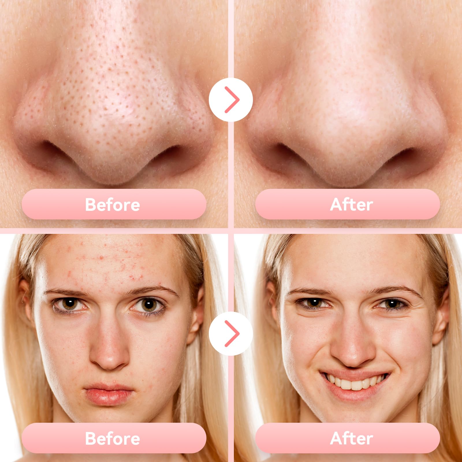 freeshow replaceable probes five types enable targeted treatment for different skin conditions.