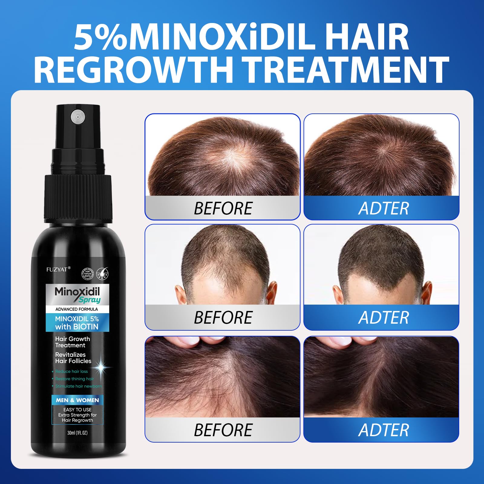 FUZYAT Biotin-Niacinamide formula cap highlights enhanced scalp nourishment.