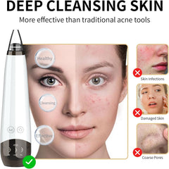 Gackoko Blackhead Remover shows suction levels for personalized cleansing.