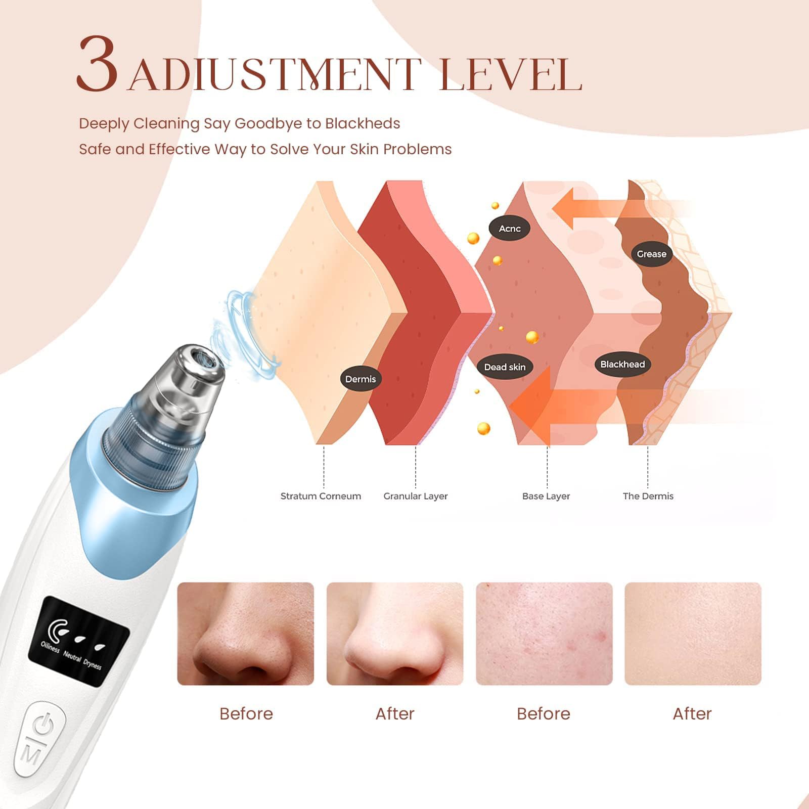 Five probes for targeted cleansing, addressing blackheads, dirt, and oil
