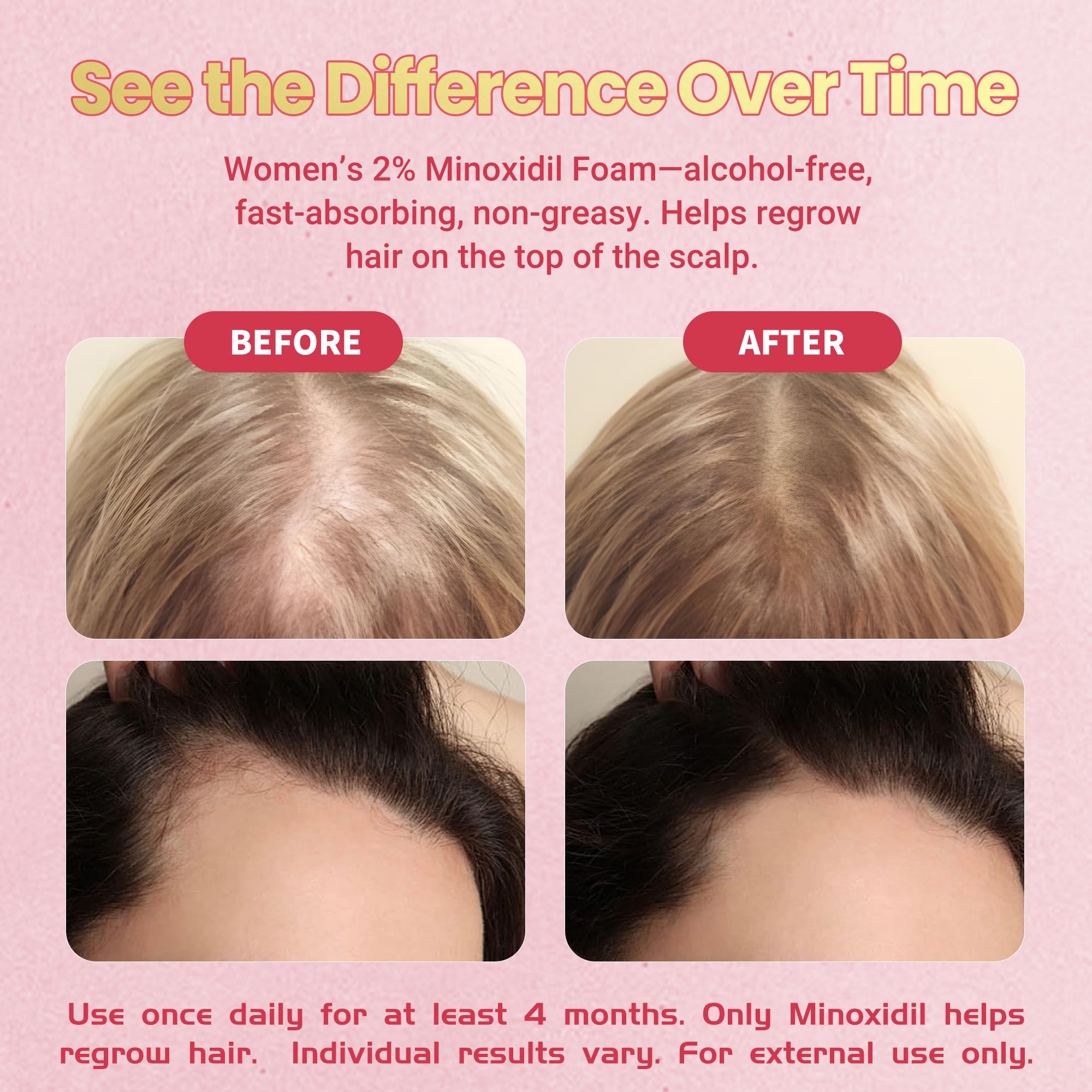Gemächlich Zu Hause Minoxidil Foam unscented keeps scalp comfortable during routine.