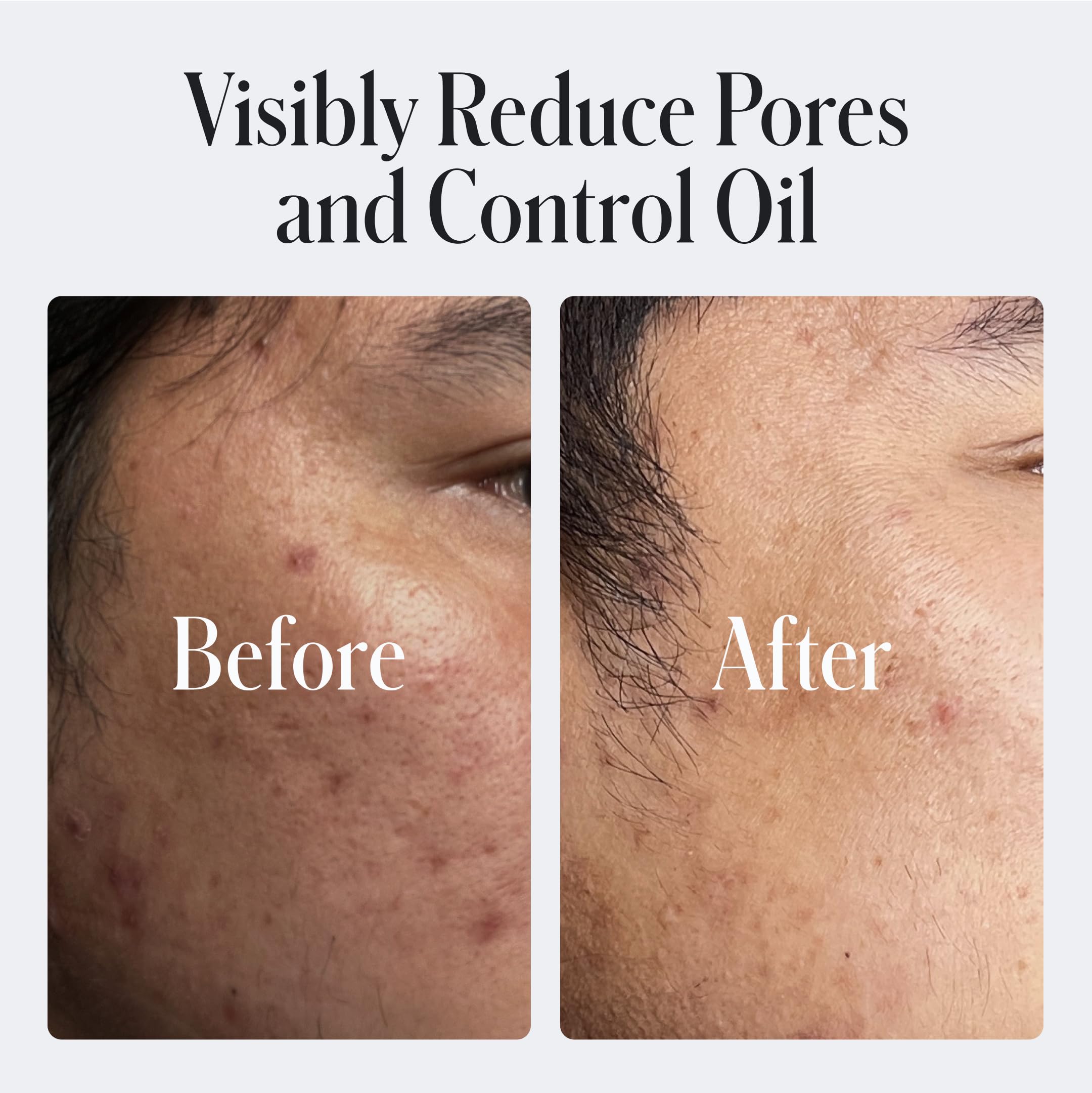 Geologie pores closeup highlights unclogging with salicylic acid for smoother skin