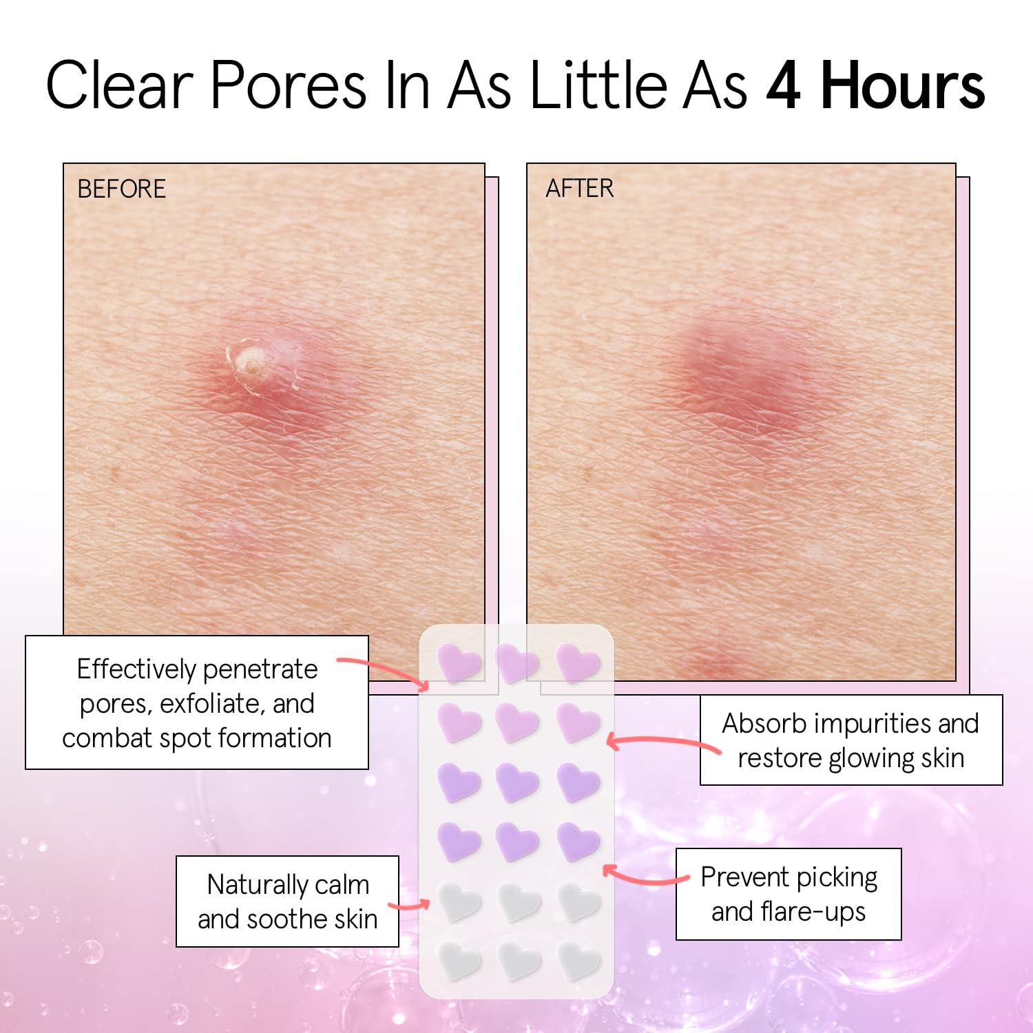 Grace & Stella hydrocolloid patches on skin illustrate moisture-absorption benefits.