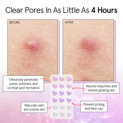 Grace & Stella hydrocolloid patches on skin illustrate moisture-absorption benefits.