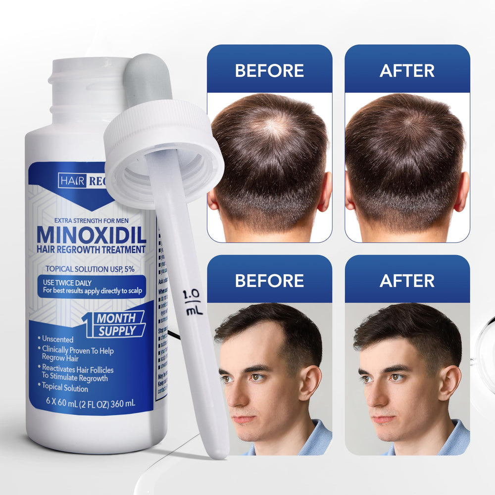 Hair Regen Minoxidil being applied on scalp for targeted treatment.