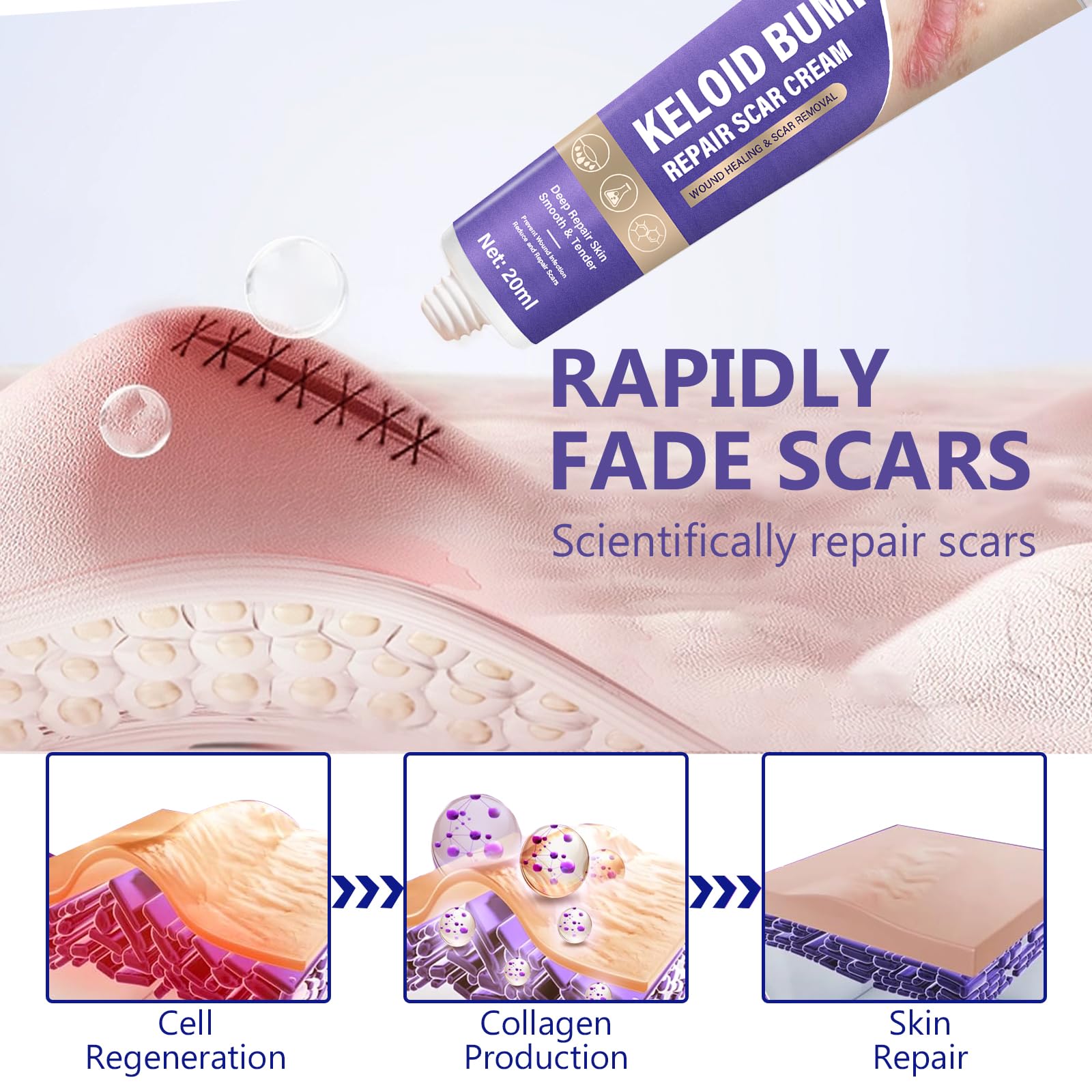 Hemir keloid bump cream on skin illustrating smoothing effect.