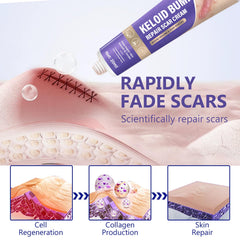 Hemir keloid bump cream on skin illustrating smoothing effect.