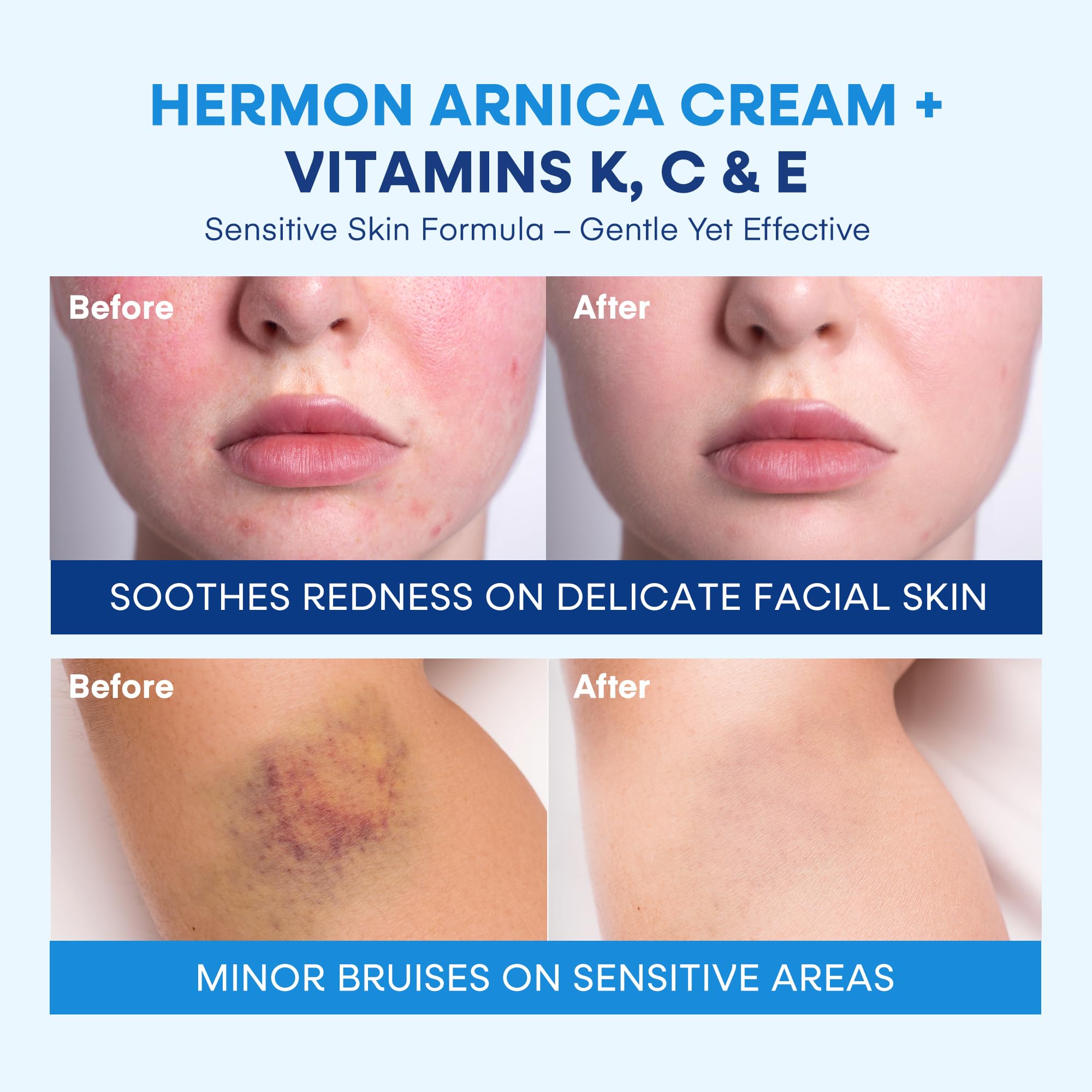 Hermon Arnica Bruise Cream applied to skin demonstrates soothing routine after minor impact.