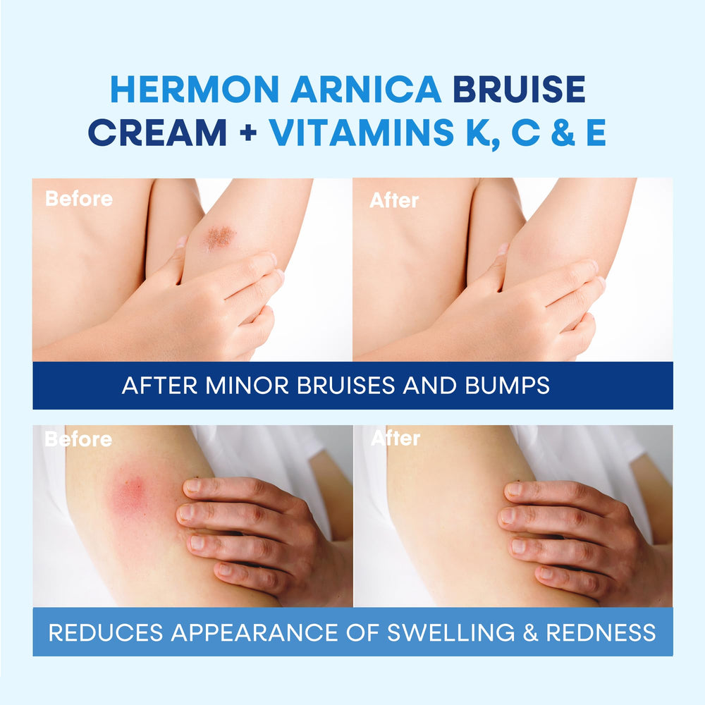 Hermon Arnica cream skin-care routine shot illustrates daily moisturizer for balanced skin.