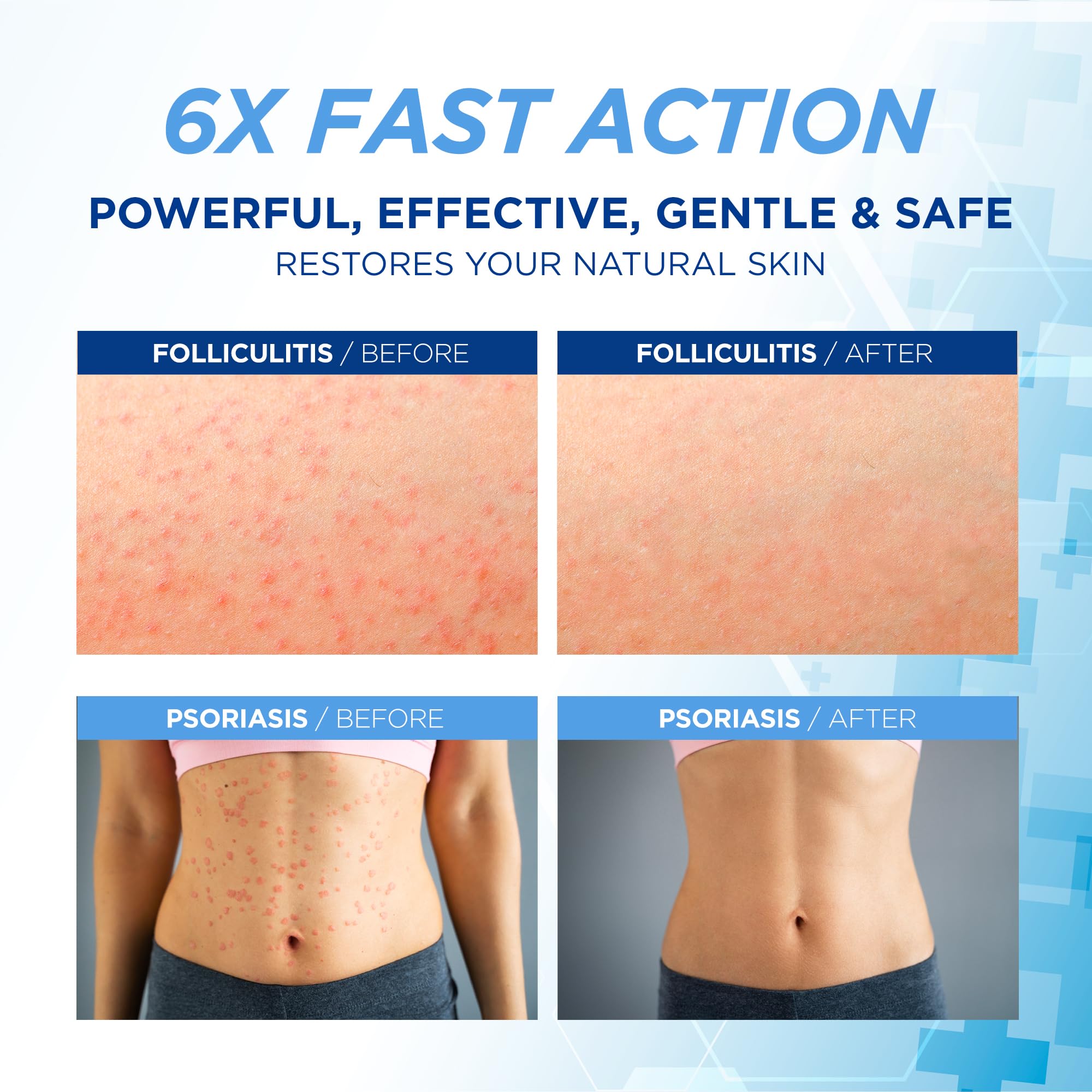 Hermon Folliculitis Cream packaging highlights natural ingredients for scalp and body care.