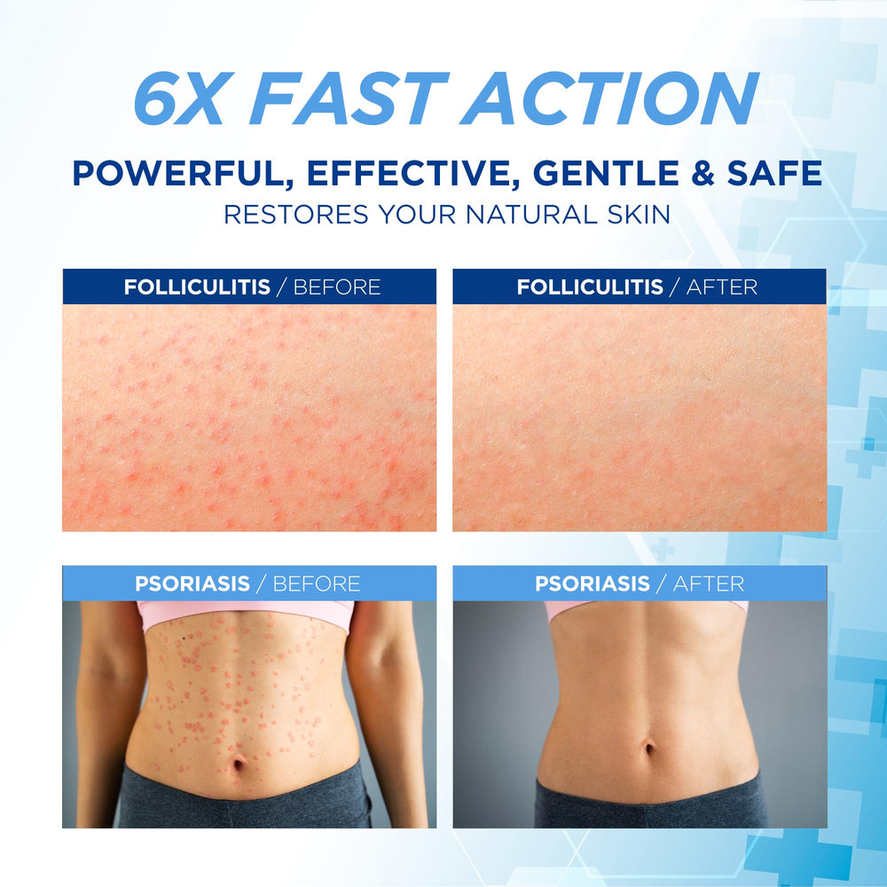 Hermon Folliculitis Cream packaging highlights natural ingredients for scalp and body care.