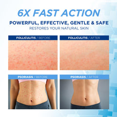Hermon Folliculitis Cream packaging highlights natural ingredients for scalp and body care.