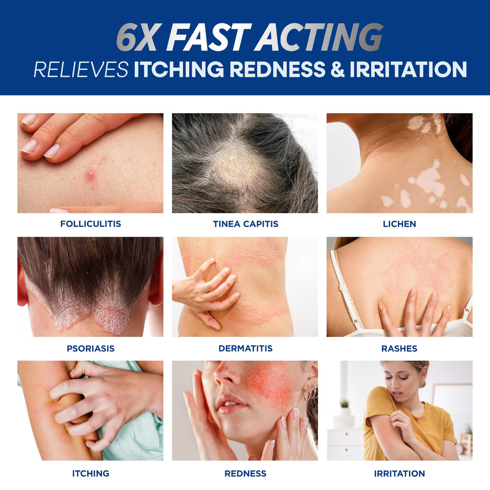 Hermon Folliculitis Cream on scalp demonstrates soothing relief during daily routine.
