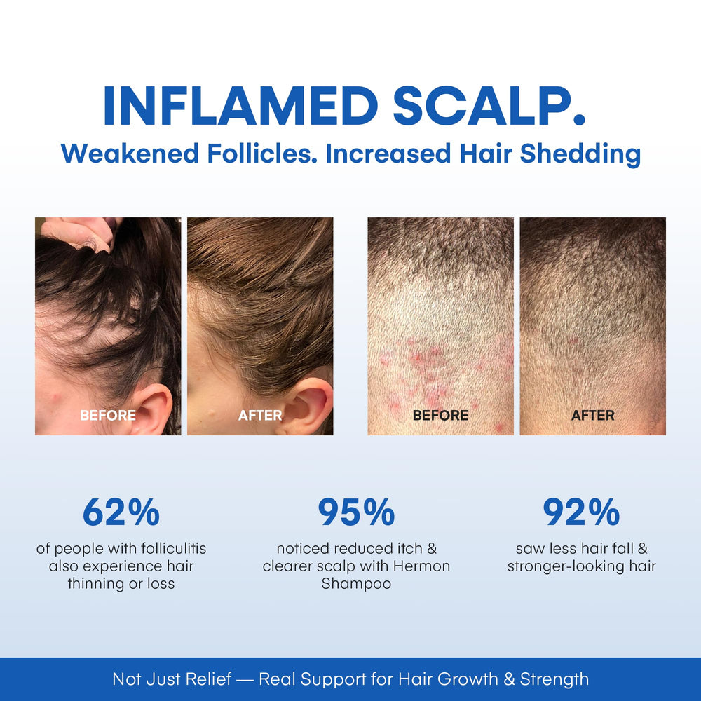 Hermon Folliculitis Shampoo application scene suggests a regular 2–3 times weekly routine