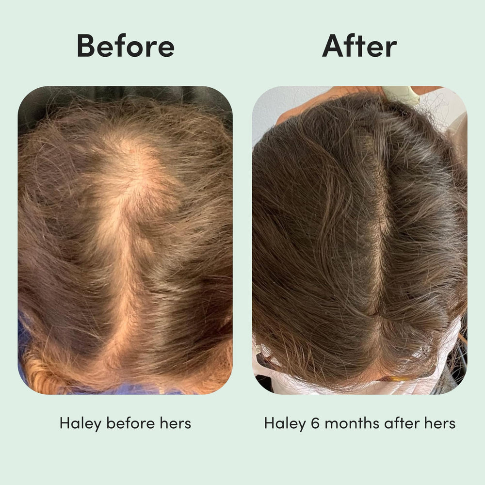 hers Hair Regrowth Closeup on hair shaft suggests thicker strands.