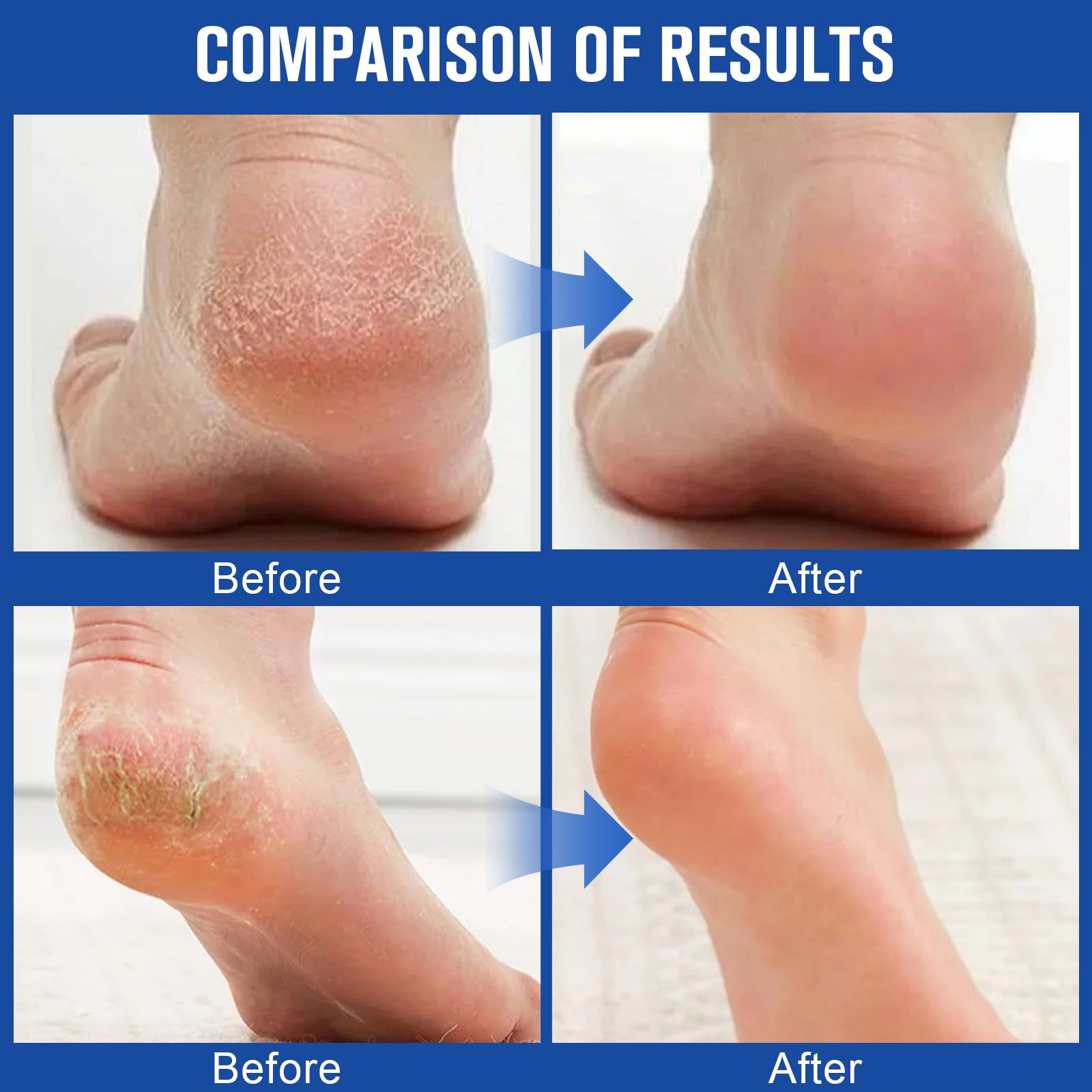 Holyarm 60% Urea cream used on hands for dryness relief