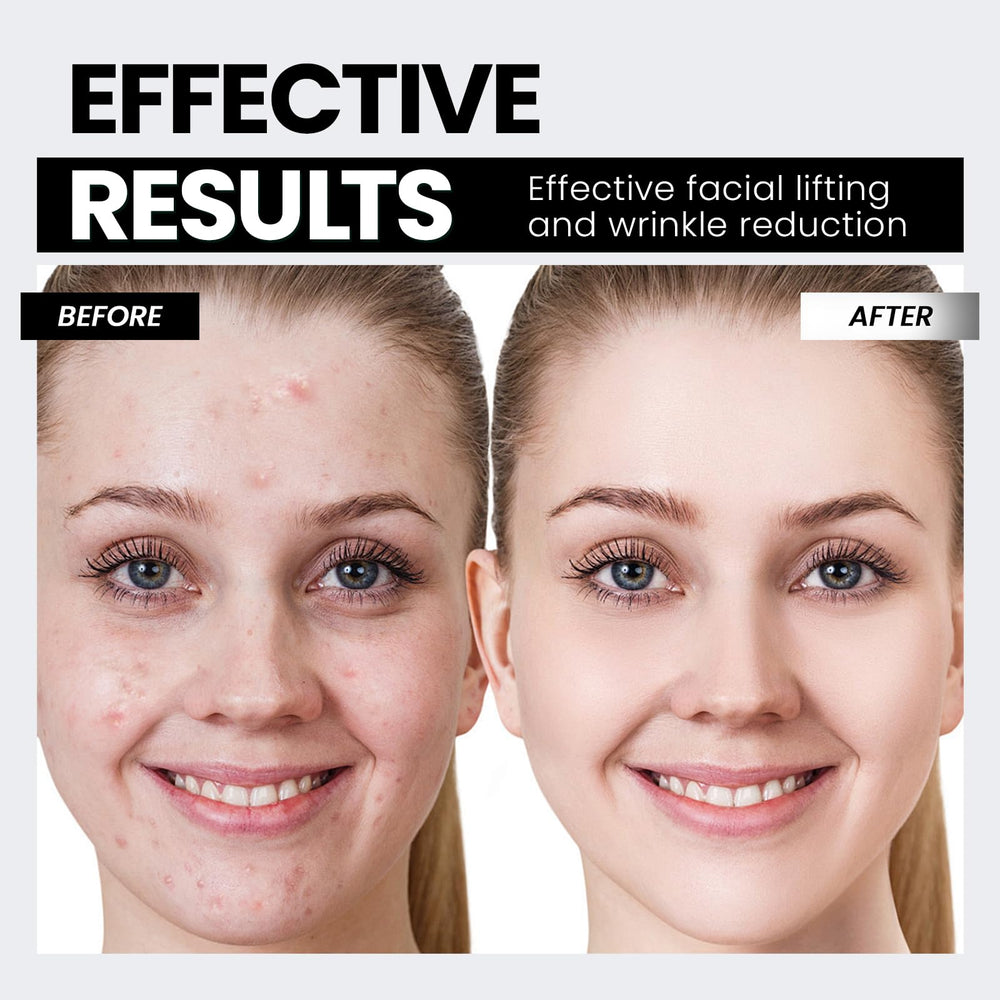 Hunvva EP-300 neck contour session demonstrating lifting effect and smoother profile.