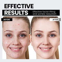 Hunvva EP-300 neck contour session demonstrating lifting effect and smoother profile.
