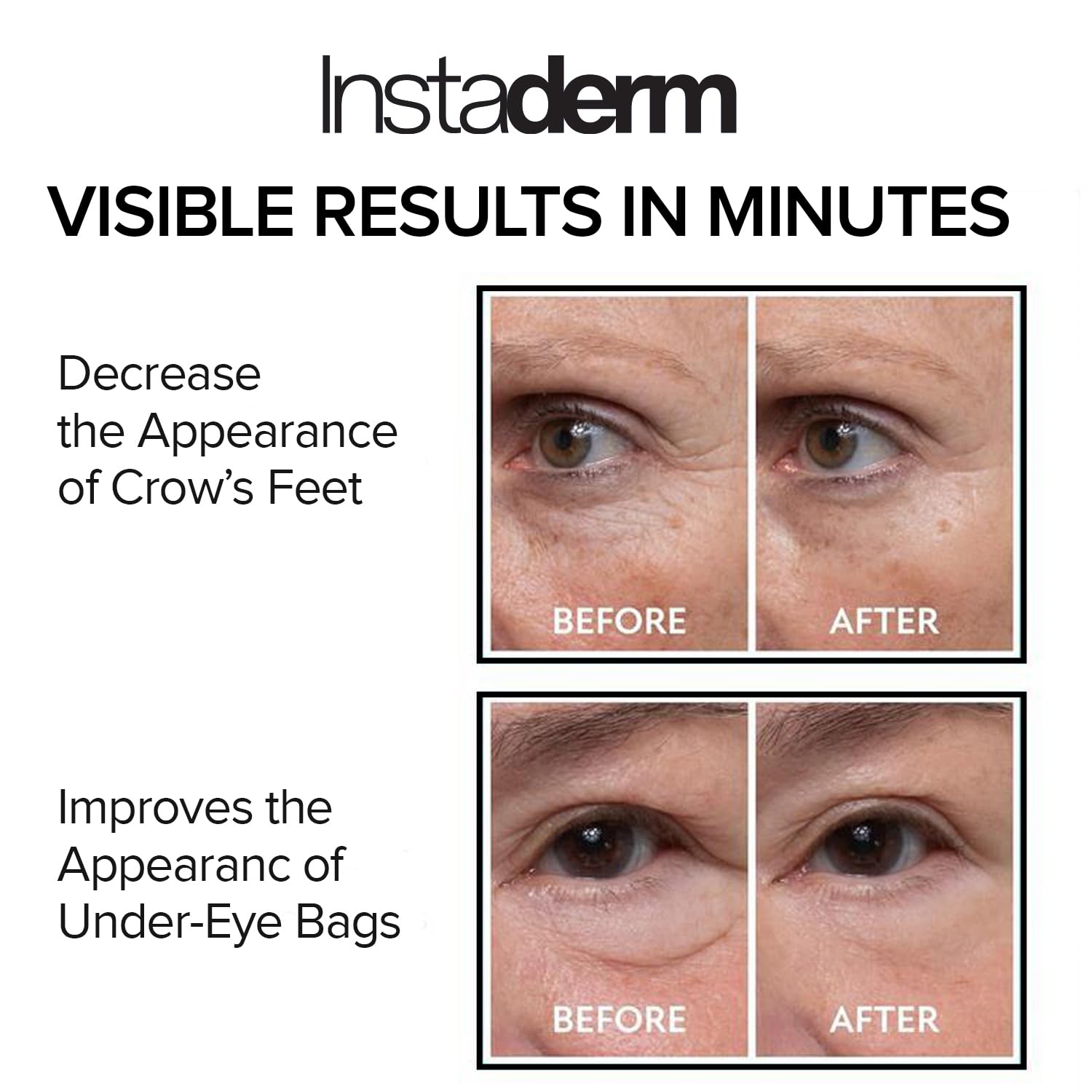 Instaderm under-eye puffiness close-up demonstrating refreshed look.