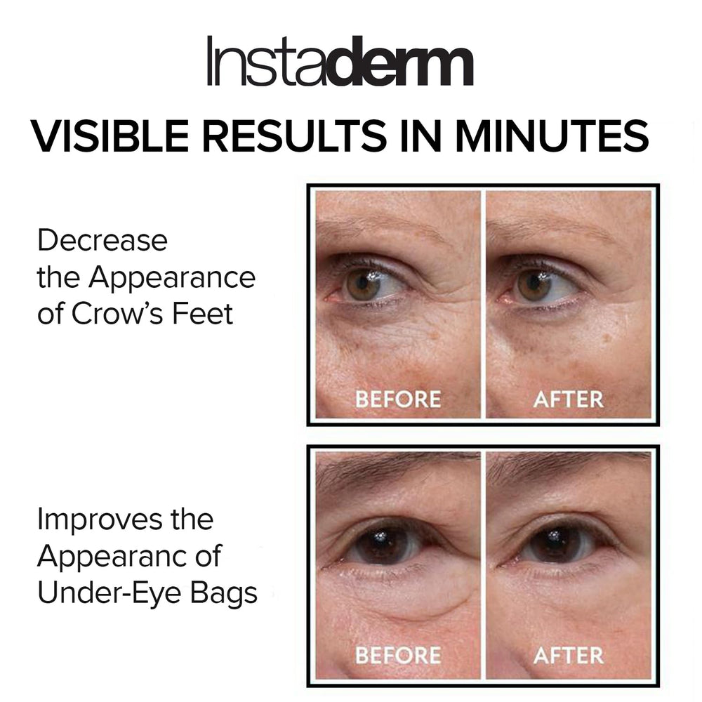Instaderm under-eye puffiness close-up demonstrating refreshed look.