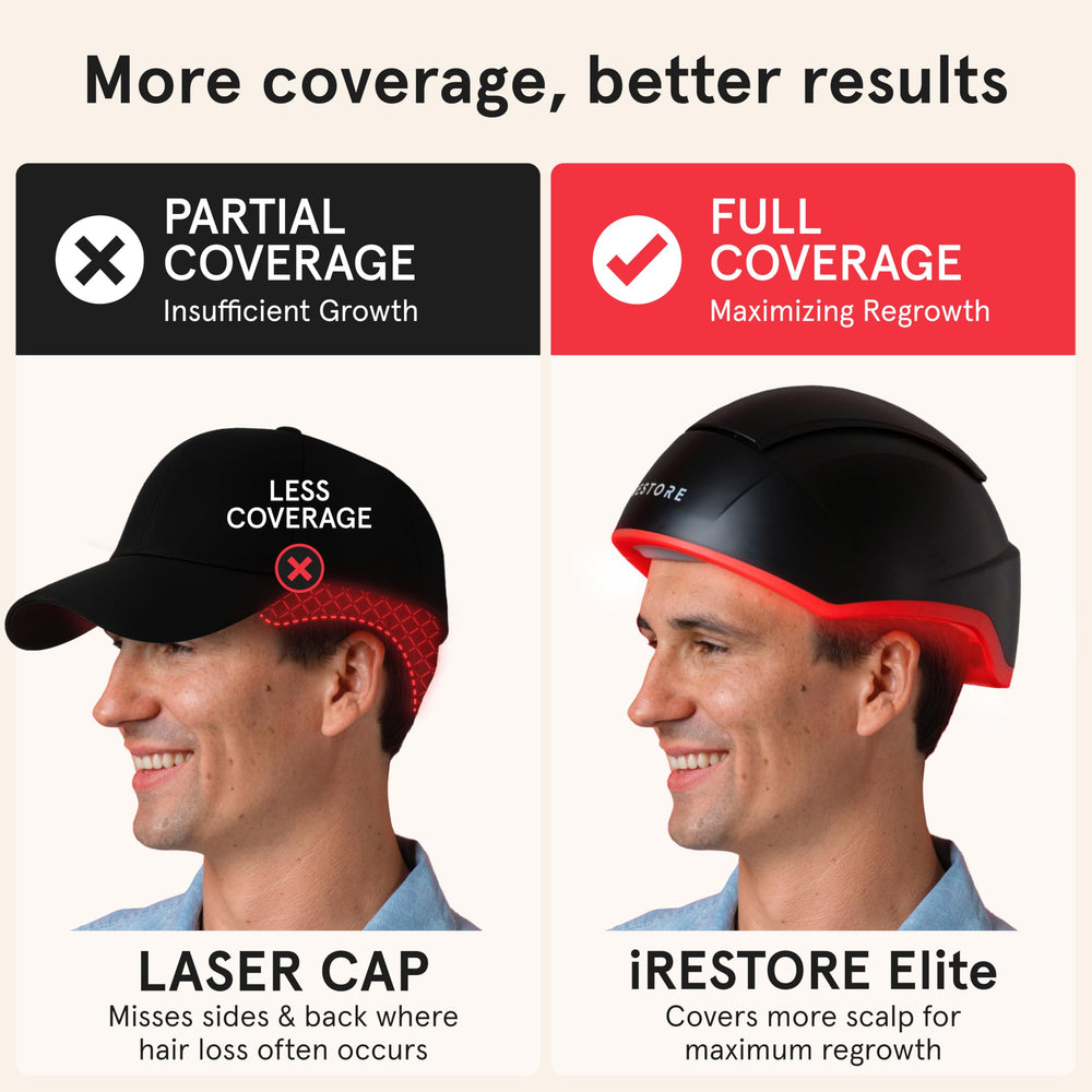 iRestore Elite scalp coverage demonstrates full hairline, temples, and crown areas.