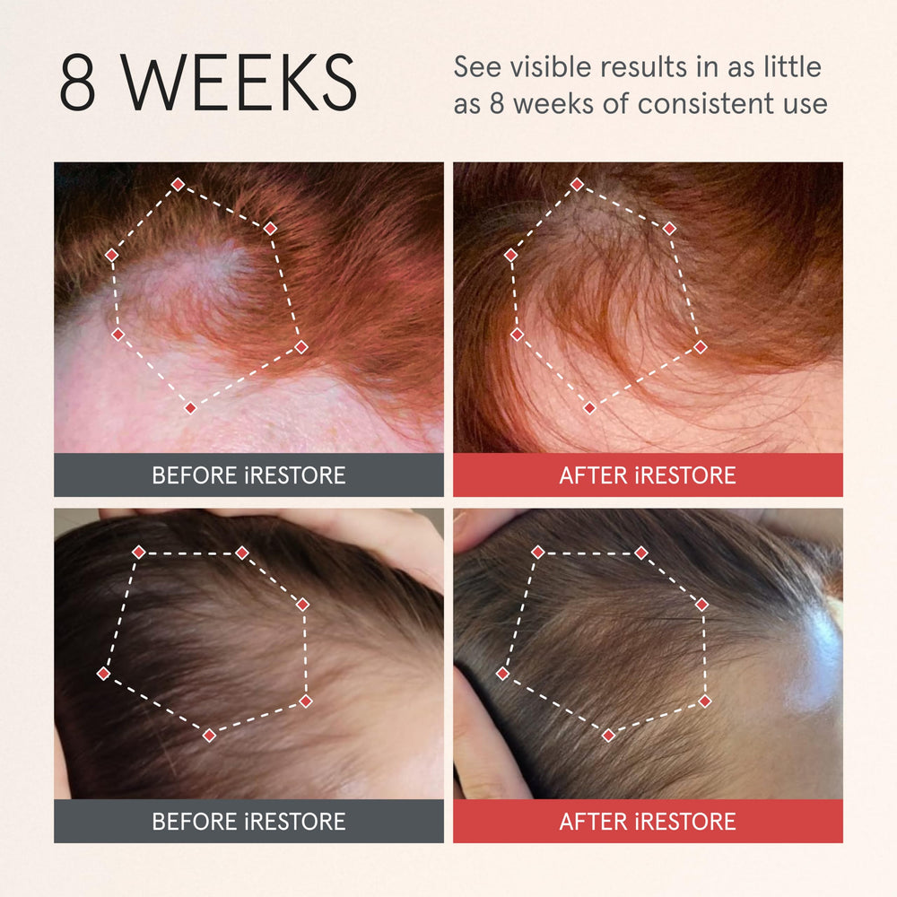 iRestore Scalp Serum with Redensyl and Biotin—premium ingredient blend for potential density.