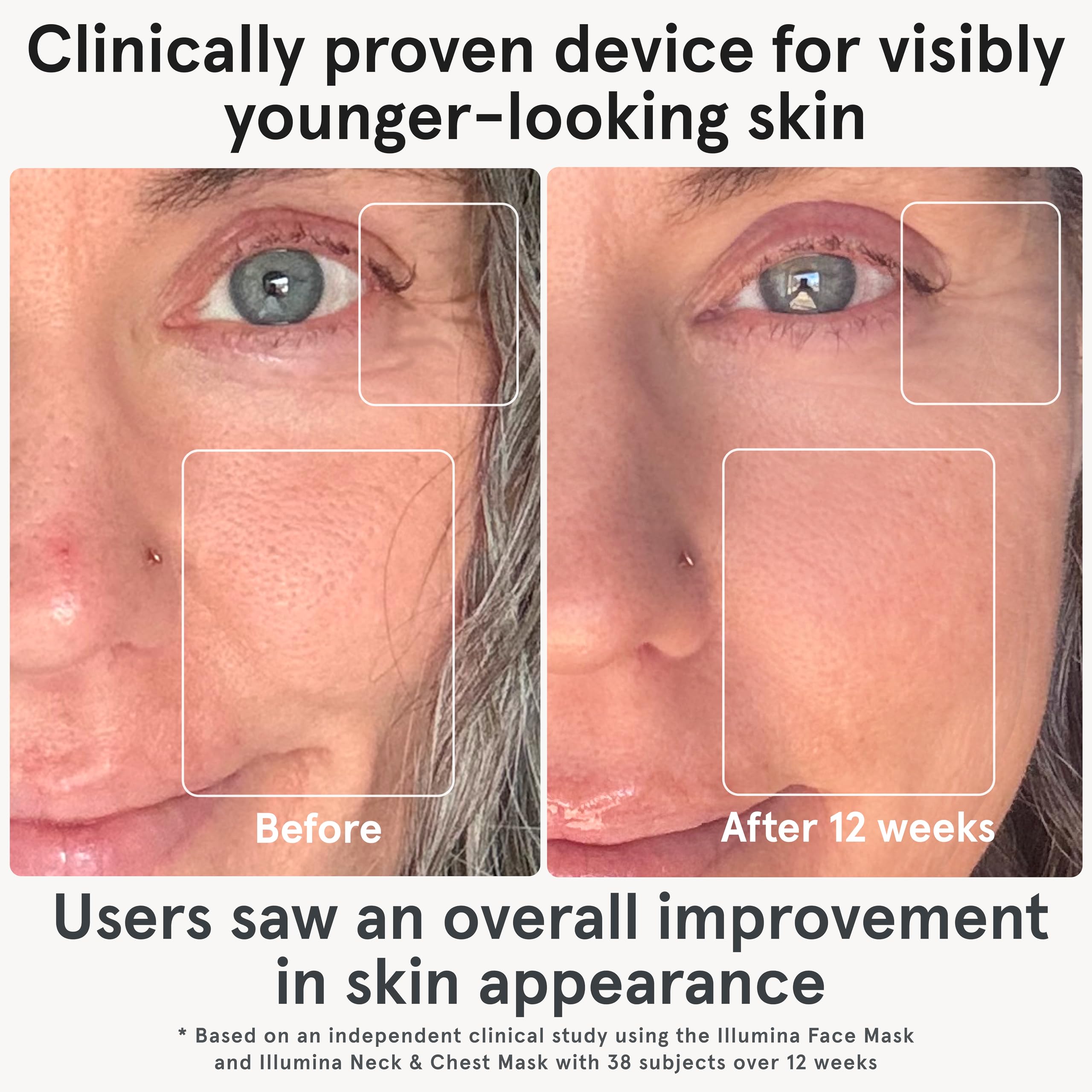 iRestore Triple-Wavelength Technology targets collagen boost and blemish care.