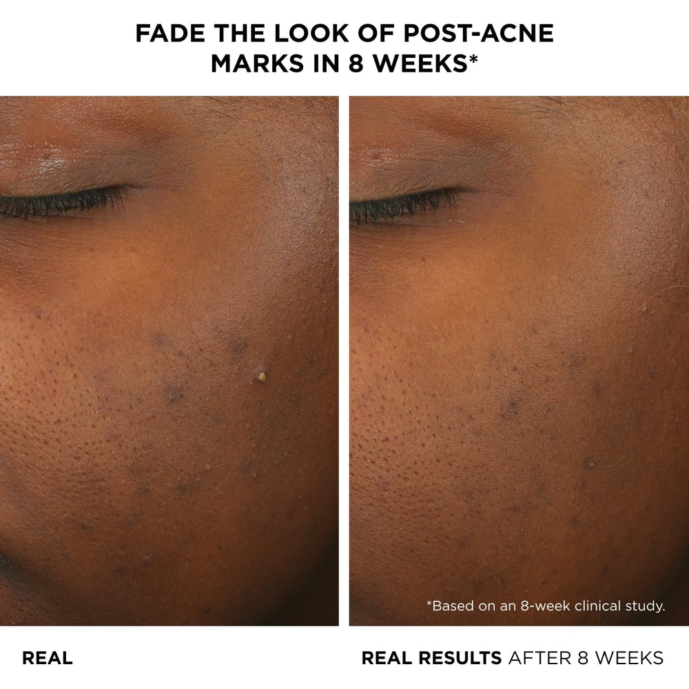 IT Cosmetics Bye Bye Breakout Serum droplet application shows precise dosing for daily spot and all-over use.