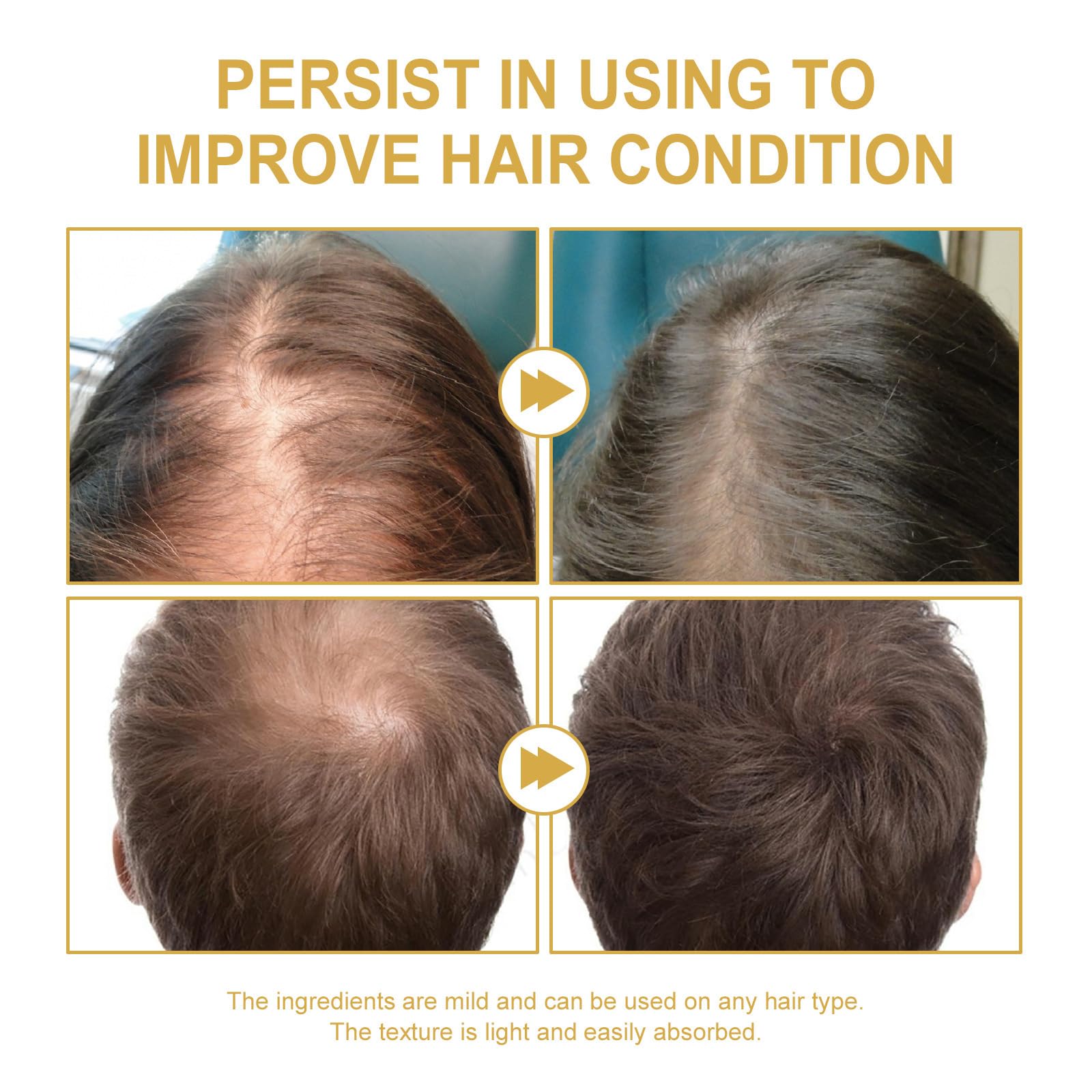 JISKG EELHOE oil dropper over scalp supports nourishment.