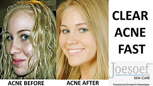 JOESOEF Anti-Acne Soap daily routine for oil control.