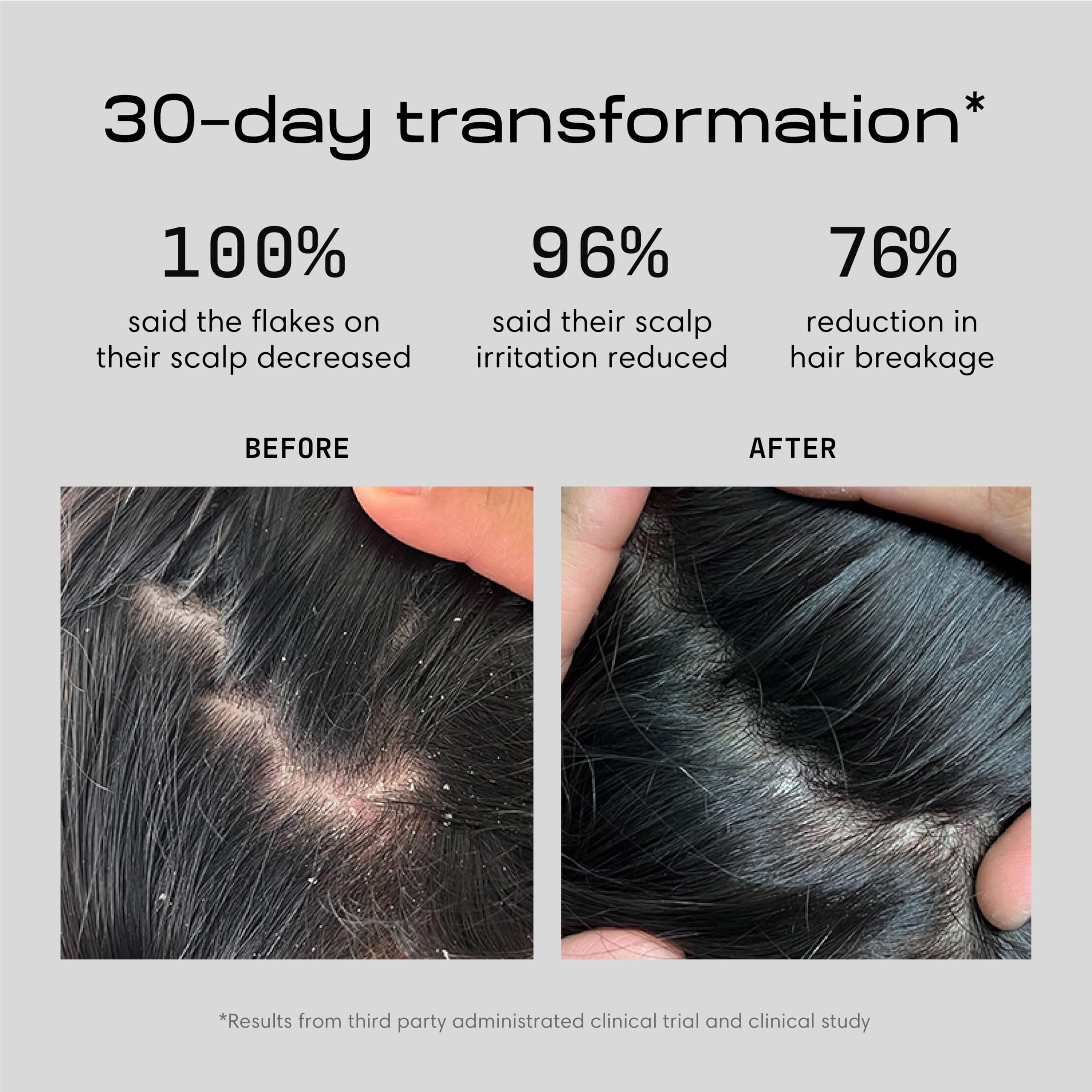 Jupiter Anti Dandruff Shampoo lather action demonstrates root cleansing for flakes and itch.