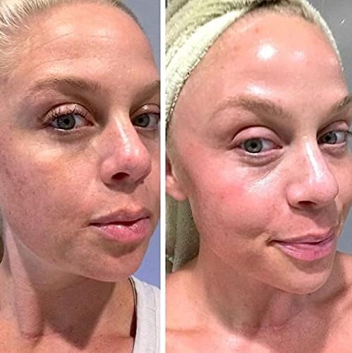 K6 Skin Care Retinol Gel applied to sun spots for gradual pigmentation balance.