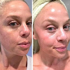 K6 Skin Care Retinol Gel applied to sun spots for gradual pigmentation balance.