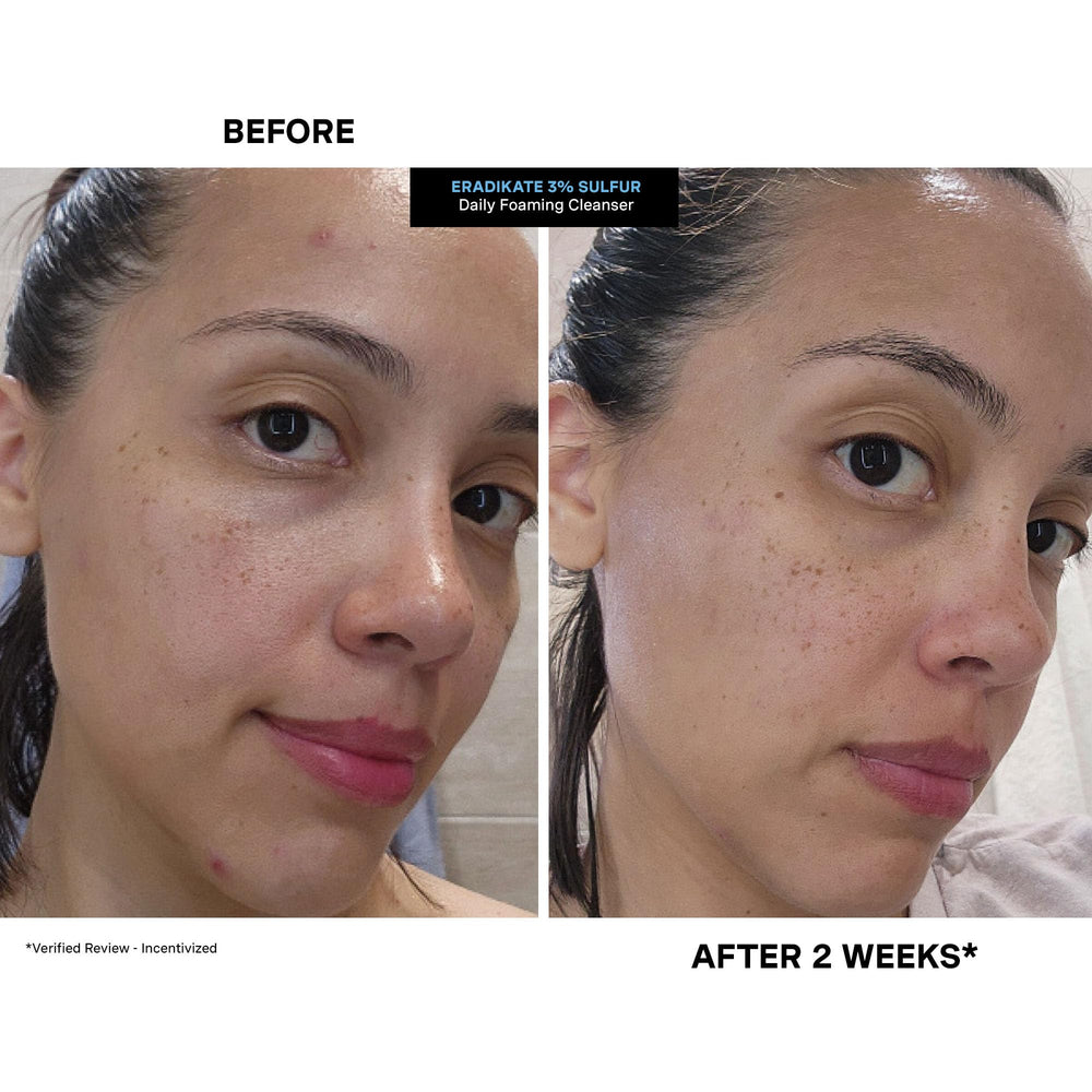 Kate Somerville EradiKate packaging-front shows accessible medicated cleanser for acne-prone skin.