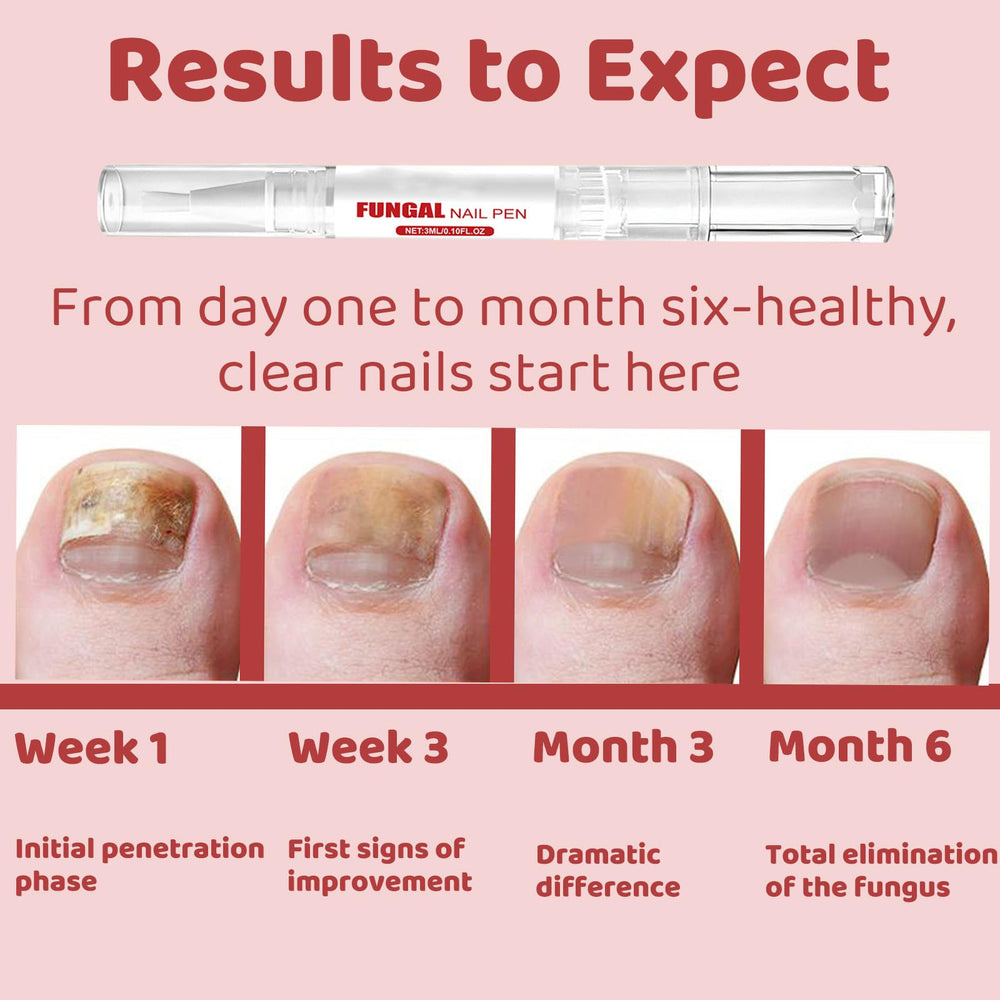 KBSBUBB Fungal Nail Pen suitable for toenails and fingernails care