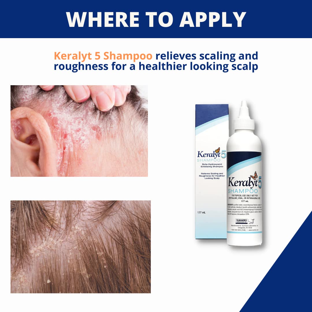 Keralyt 5 label close-up highlighting 5% salicylic acid for scalp exfoliation