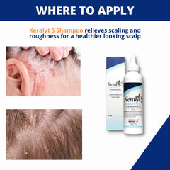 Keralyt 5 label close-up highlighting 5% salicylic acid for scalp exfoliation