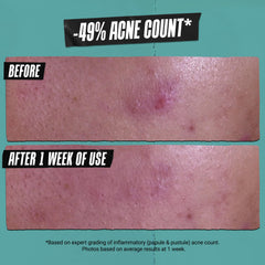 Kiehl's Acne-Treating Paste contains 2% salicylic acid to target breakouts.