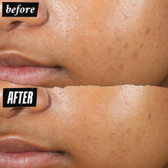 Kiehl's patch ingredients Niacinamide for brightening and reducing post-blemish marks.