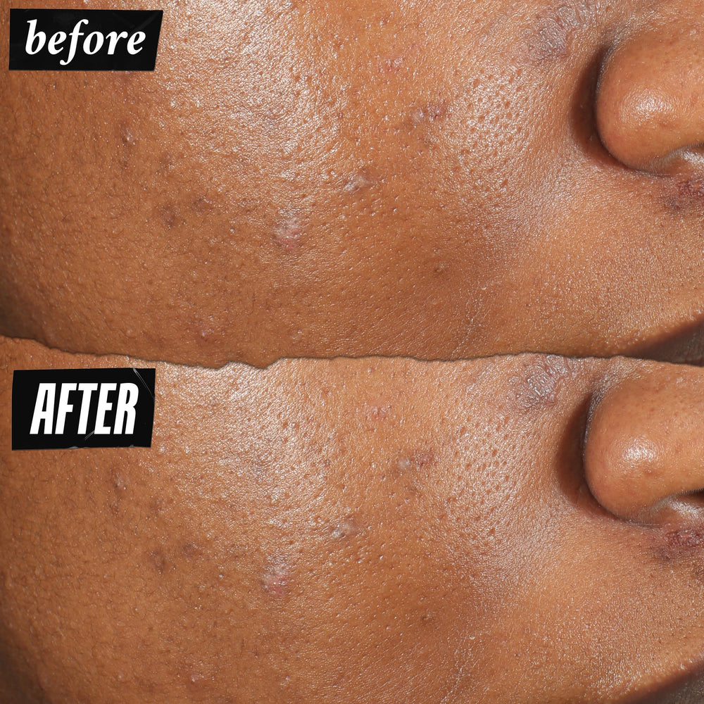 Kiehl's patch shows visible results on blemish after use.